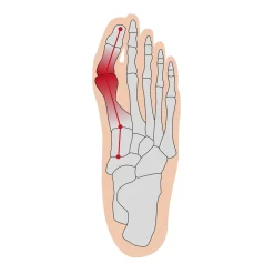 Hallux Soft Bandage rechts